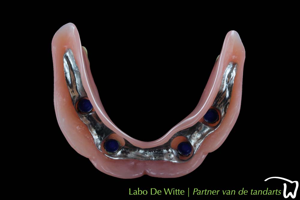 opbouwen Goedaardig Postcode Overkappingsprothese of hybride prothese - Labo De Witte - partner van de  tandarts